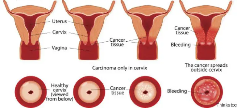 9 Signs That Might Indicate You Have Cervical Cancer- Don’t Ignore Them!