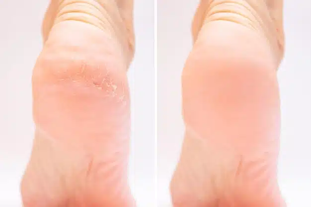 before and after dry heels treatment
