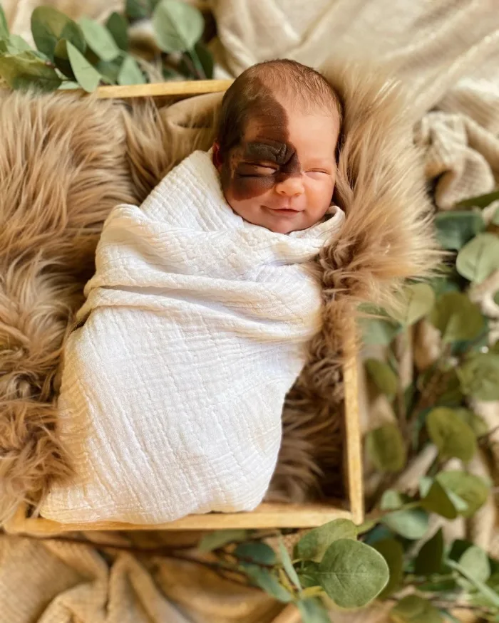 Newborn with congenital melanocytic nevus