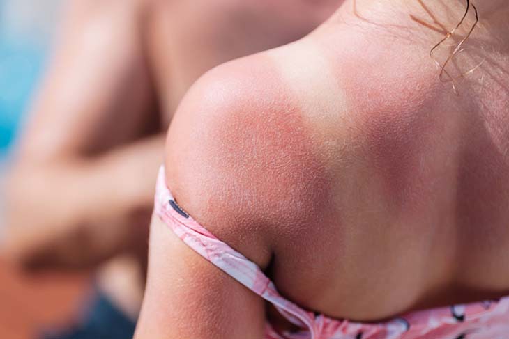 sunburn