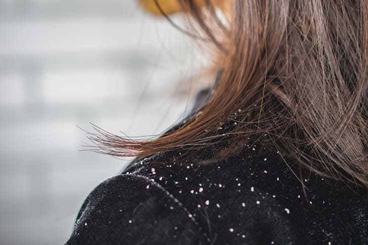 dandruff on hair