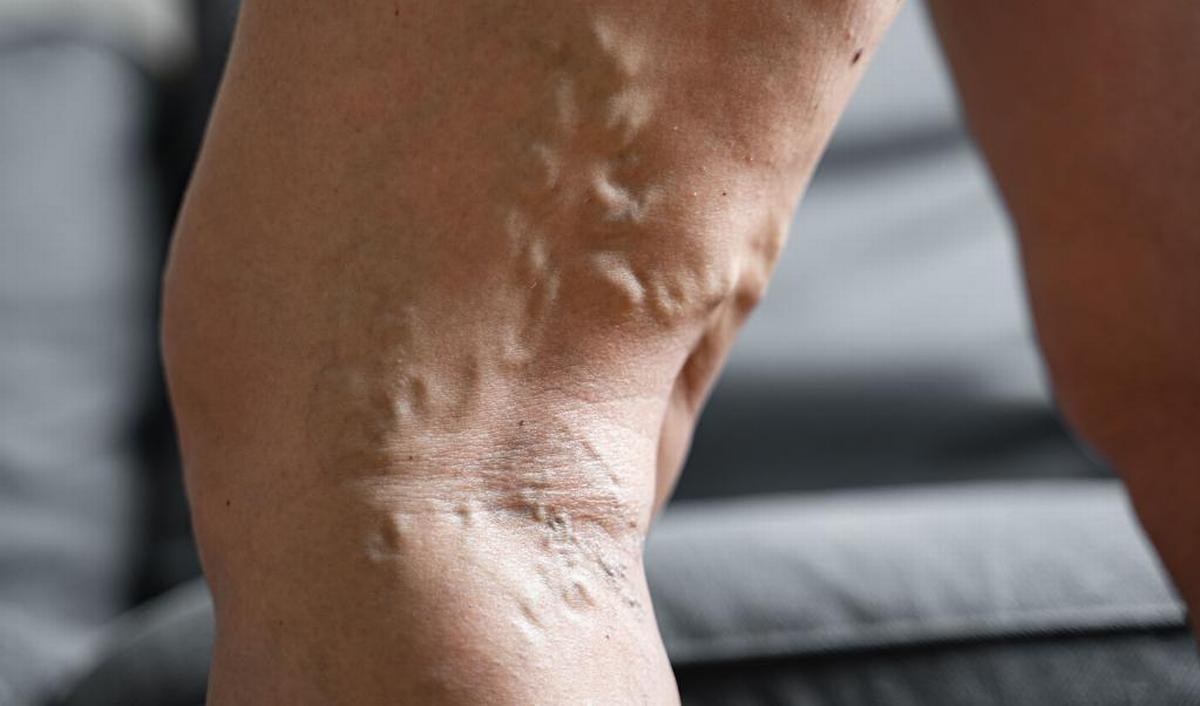 Swollen Veins