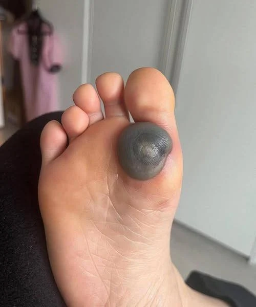 Large blister on a child's foot