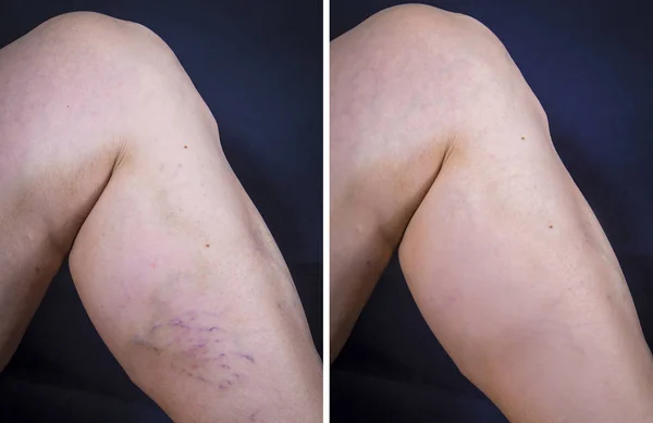 Leg with Varicose Veins